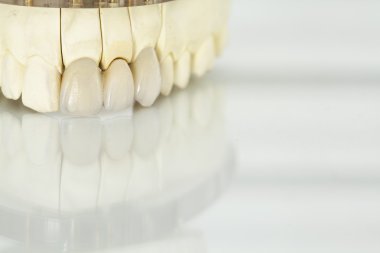 Metalsiz seramik diş kaplamaları