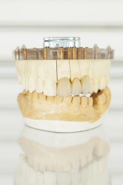 Metal free ceramic dental crowns clipart