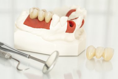 Metalsiz seramik diş kaplamaları