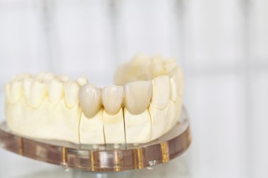 Metalsiz seramik diş kaplamaları