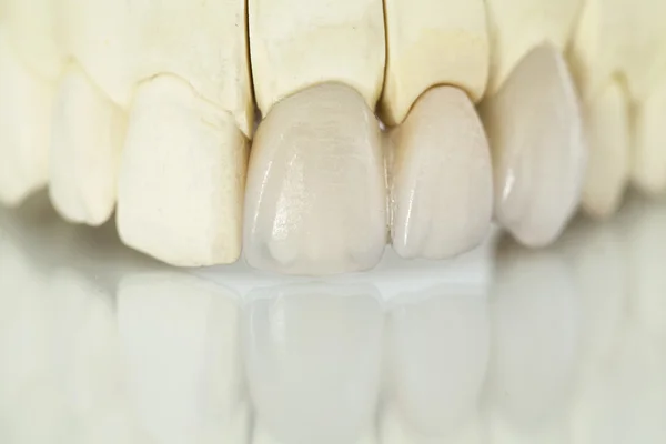 Coronas dentales de cerámica sin metal — Foto de Stock