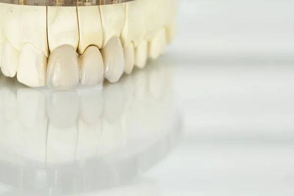 Ceramiczne korony dentystyczne bez metalu — Zdjęcie stockowe