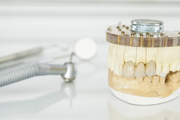 Coronas dentales de cerámica sin metal — Foto de Stock