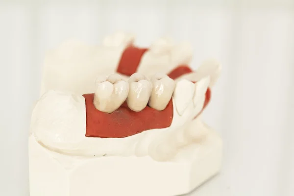 Corone dentali in ceramica senza metallo — Foto Stock