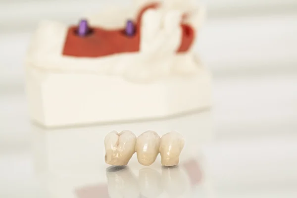 Kovové zdarma keramické zubní korunky — Stock fotografie