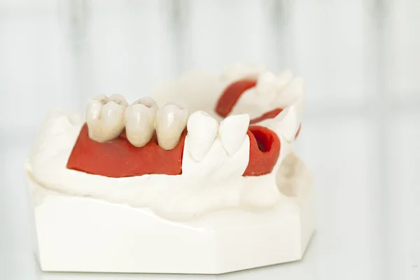 Corone dentali in ceramica senza metallo — Foto Stock