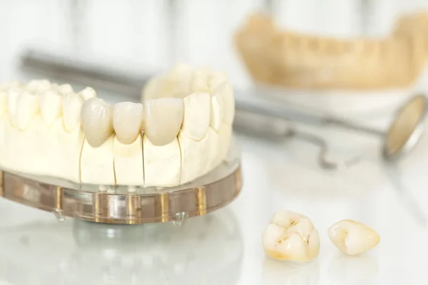 Κεραμικές οδοντιατρικές κορώνες χωρίς μέταλλα — Φωτογραφία Αρχείου