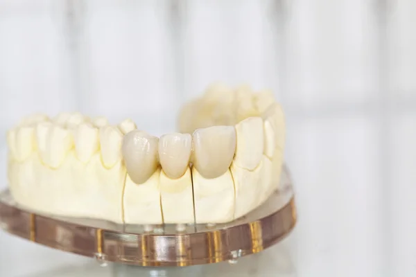 Coronas dentales de cerámica sin metal —  Fotos de Stock