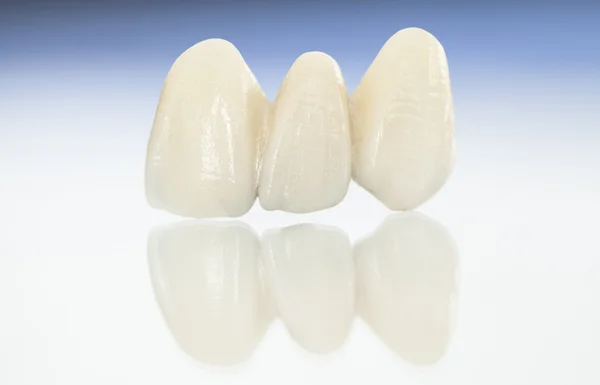 Coroas dentárias de cerâmica livre de metal — Fotografia de Stock