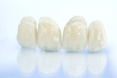 Metalsiz seramik diş kaplamaları