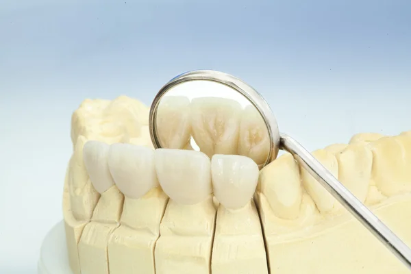 Metal free ceramic dental crowns — Stock Photo, Image