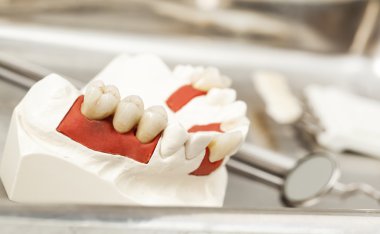 Alçı model üzerinde seramik Köprüsü