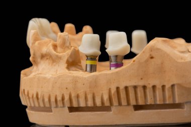 Siyah cam arka planda dişçi alt çene protezinin yakın görüntüsü. Kaplamalı ve kaplamalı yapay çene. İmplantla diş çıkarma. Diş hekiminin kavramsal fotoğrafı. Protez dişçilik