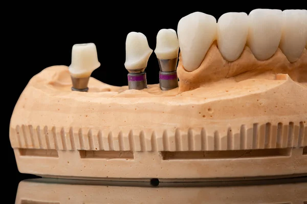 Close-up photo of a dental upper jaw prosthesis on black glass background. Artificial jaw with veneers and crowns. Tooth recovery with implant. Dentistry conceptual photo. Prosthetic dentistry. — 图库照片