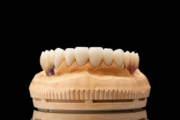 Close-up front view of a dental upper jaw prosthesis on black glass background. Artificial jaw with veneers and crowns. Tooth recovery with implant. Dentistry conceptual photo. Prosthetic dentistry. — Stock Photo, Image
