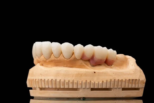 在黑色玻璃背景的牙齿上颌骨假体的特写侧视图 人造下颚 有镶边和冠冕 植入物的牙齿恢复 牙科学概念照片 — 图库照片