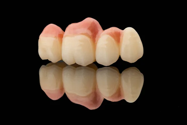人工歯茎に4本の歯の歯科ブリッジ 黒ガラスの背景に隔離されたセラミック歯冠のクローズアップ写真 インプラントで歯の回復 歯の概念写真 — ストック写真