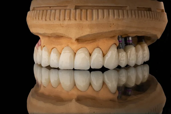 Close-up photo of a dental upper jaw prosthesis on black glass background. Artificial jaw with veneers and crowns. Tooth recovery with implant. Dentistry conceptual photo.