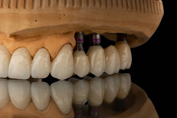 在黑色玻璃背景上的牙齿上颌骨假体的特写照片 人造下颚 有镶边和冠冕 植入物的牙齿恢复 牙科学概念照片 — 图库照片