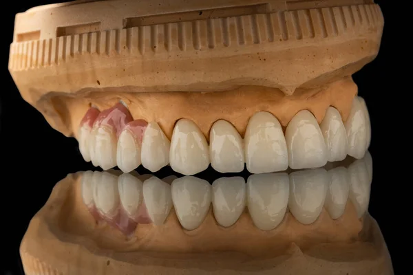 在黑色玻璃背景上的牙齿上颌骨假体的特写照片 人造下颚 有镶边和冠冕 植入物的牙齿恢复 牙科学概念照片 — 图库照片