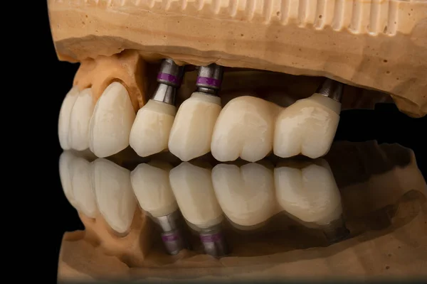 在黑色玻璃背景的牙齿上颌骨假体的特写侧视图 人造下颚 有镶边和冠冕 植入物的牙齿恢复 牙科学概念照片 假牙科 — 图库照片