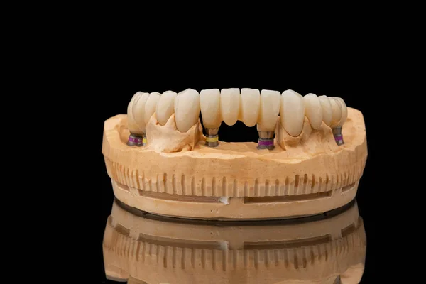 在黑色玻璃背景下的下下颌骨假体的特写前视图 人造下颚 有镶边和冠冕 植入物的牙齿恢复 牙科学概念照片 — 图库照片