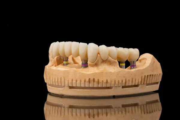 在黑色玻璃背景下的下颌骨假牙的特写侧视图 人造下颚 有镶边和冠冕 植入物的牙齿恢复 牙科学概念照片 — 图库照片