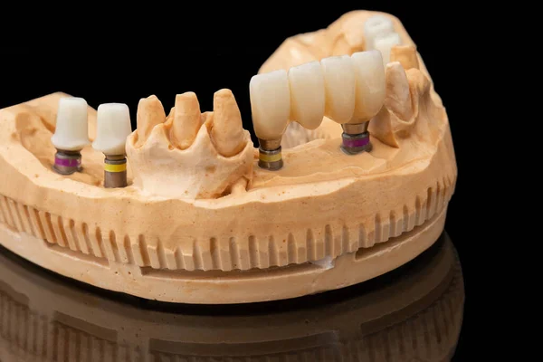 在黑色玻璃背景下的牙齿下颌骨假体的特写照片 人造下颚 有镶边和冠冕 植入物的牙齿恢复 牙科学概念照片 假牙科 — 图库照片