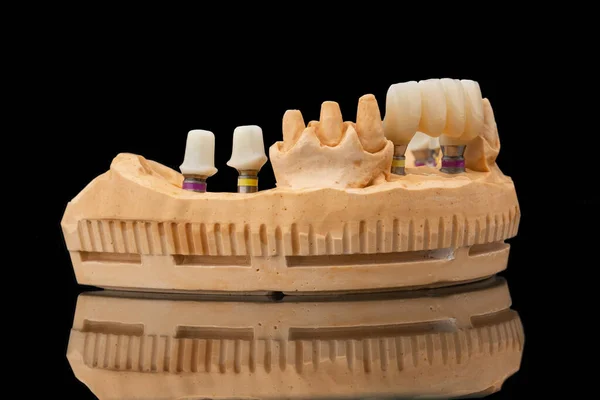 在黑色玻璃背景下的下颌骨假牙的特写侧视图 人造下颚 有镶边和冠冕 植入物的牙齿恢复 牙科学概念照片 假牙科 — 图库照片