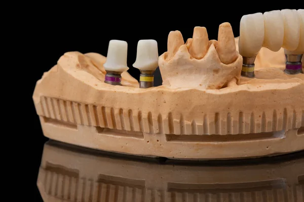 在黑色玻璃背景下的下颌骨假牙的特写侧视图 人造下颚 有镶边和冠冕 植入物的牙齿恢复 牙科学概念照片 假牙科 — 图库照片