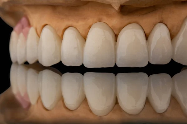 Vista frontal de cerca de una prótesis dental de mandíbula superior sobre fondo de vidrio negro. Mandíbula artificial con chapas y coronas. Recuperación dental con implante. Foto conceptual de odontología. Prótesis odontológica. — Foto de Stock