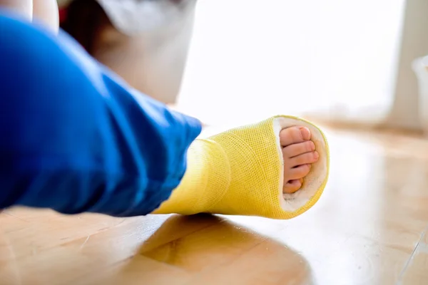 Beinbruch bei Gips von unkenntlich gemachtem kleinen Jungen. — Stockfoto