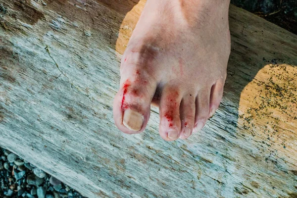 Mans bleeding bare feet after being cut by sharp rocks at an ocean beach