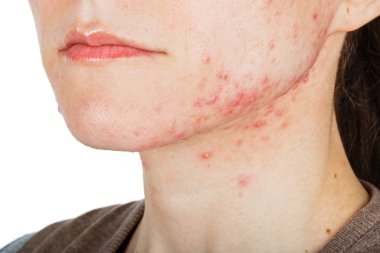  cilt sorunu ile genç kız