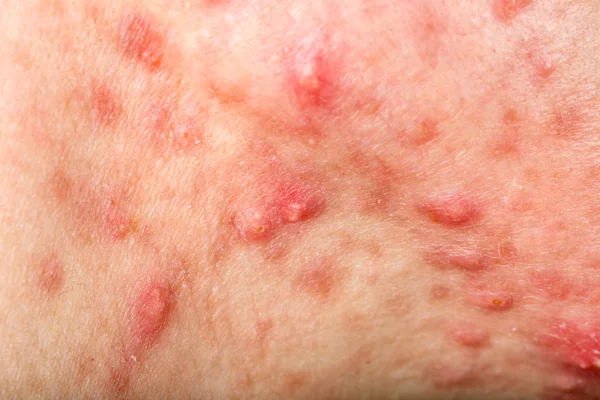 cystic acne svenska cystic acne svenska