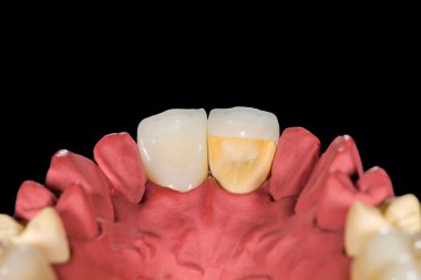 Dental ceramic crowns clipart