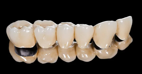 Puente de cerámica dental — Foto de Stock