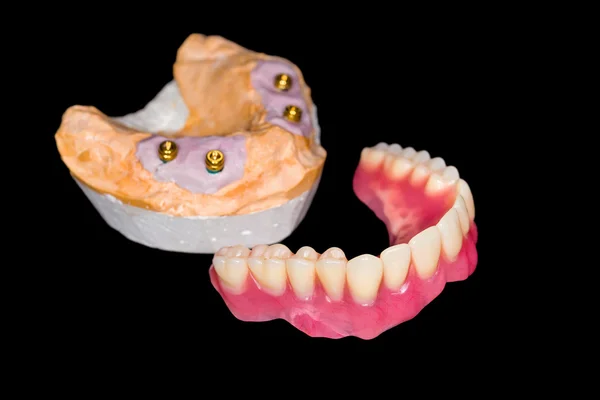 Dentiera rimovibile — Foto Stock