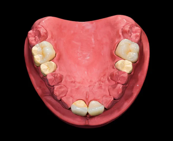 Ceramiczne korony dentystyczne — Zdjęcie stockowe