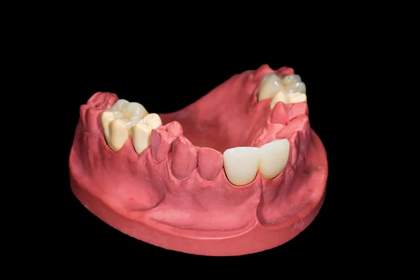 Ceramiczne korony dentystyczne — Zdjęcie stockowe