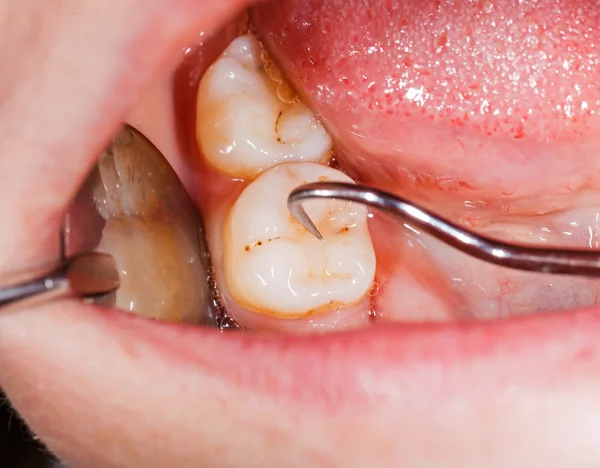 Zubní vyšetření — Stock fotografie