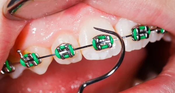 Teeth with braces — Stock Photo, Image