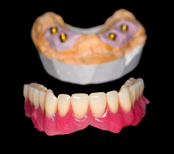 可摘义齿修复 — 图库照片