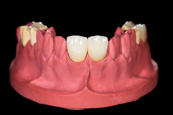 Ceramiczne korony dentystyczne — Zdjęcie stockowe