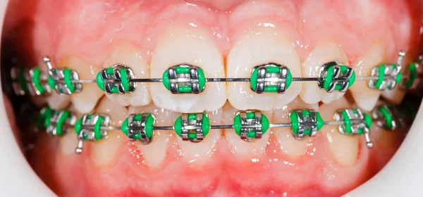 Aparelhos nos dentes — Fotografia de Stock