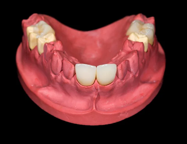 Dentální Keramické korunky — Stock fotografie