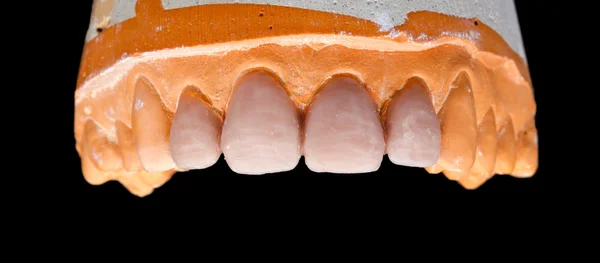 Модель верхнего зубного гипса — стоковое фото