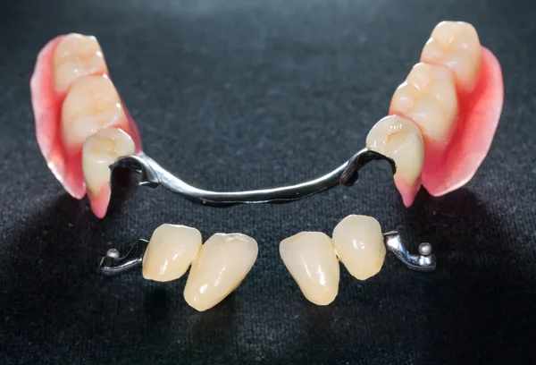 Protesi dentaria rimovibile — Foto Stock