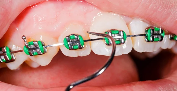 Dientes con ortodoncia — Foto de Stock