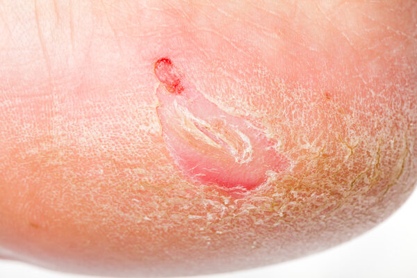 Dry skin on heel